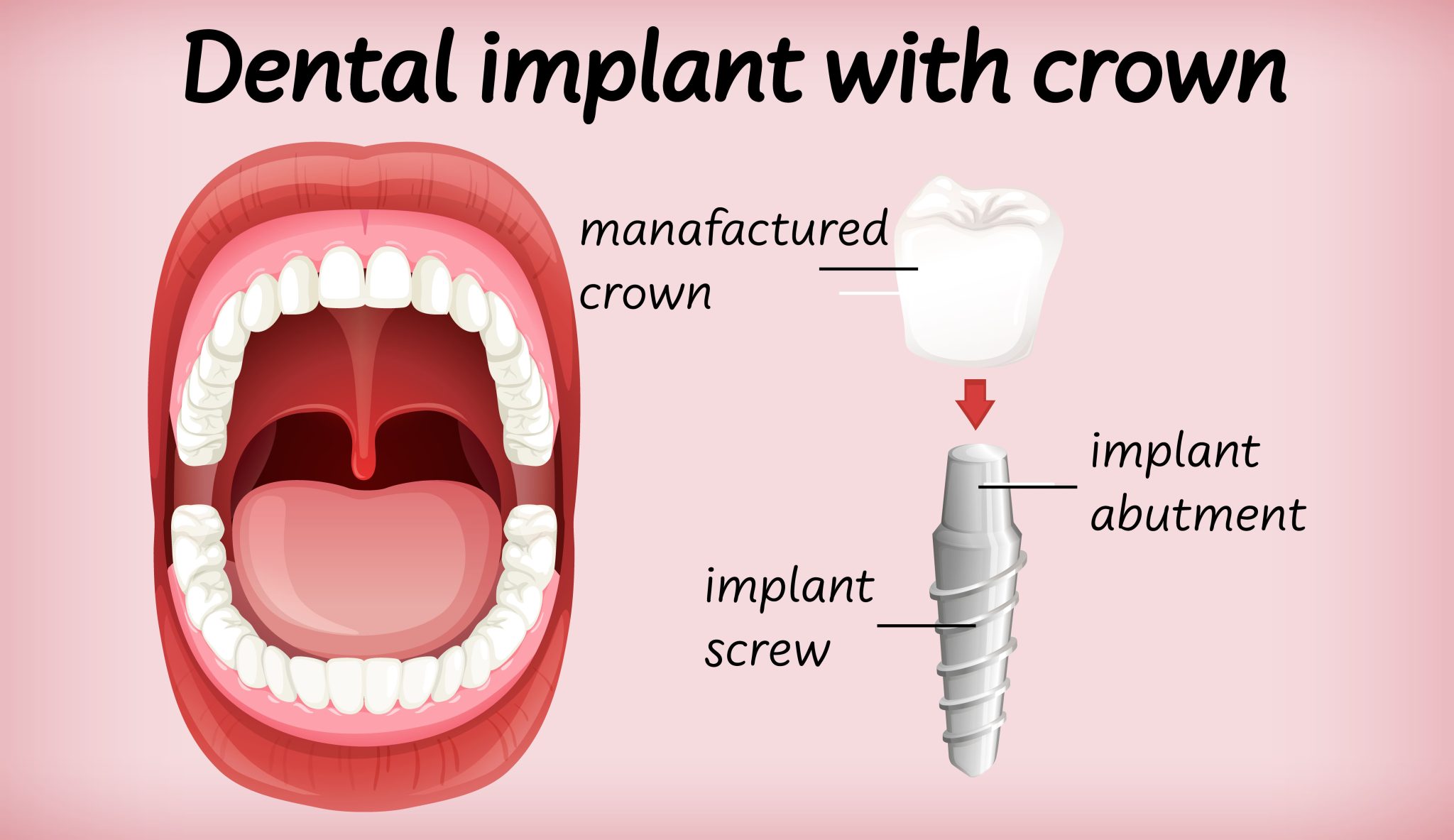 Can You Get Dental Implants If You Have Gum Disease