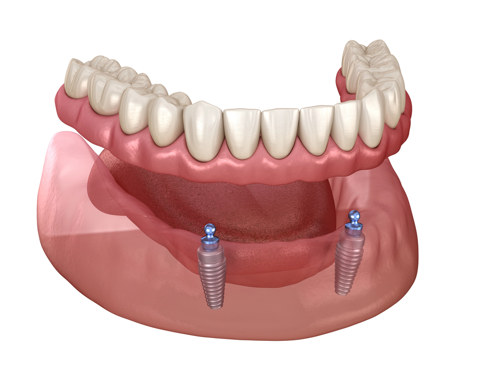 Dental Implants in Yorkville